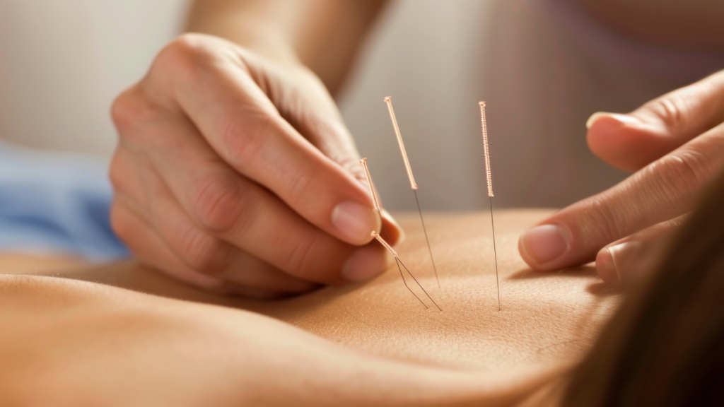 Акупунктура
