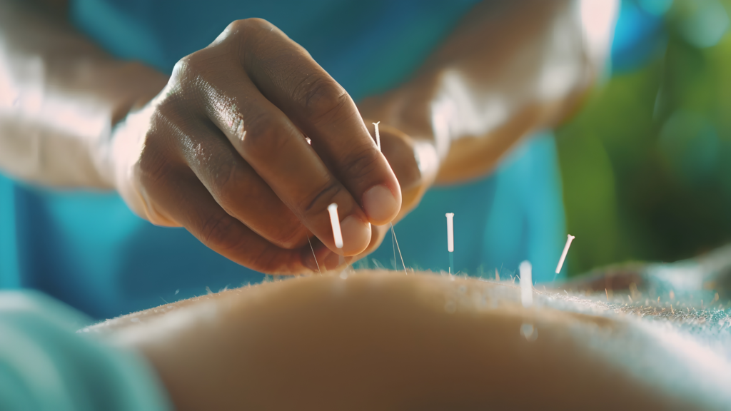 Акупунктура