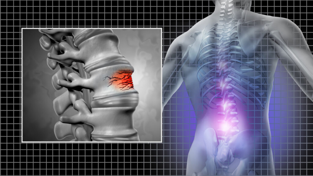Симптомы грыжи Шморля